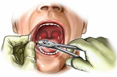 Dental Extraction