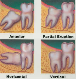 All Smiles Dental | Impacted Wisdom Tooth - Dentist Geelong