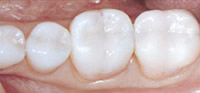 All Smiles Dental | Inlays : Onlays - Dentist Geelong