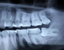 All Smiles Dental | Wisdom Teeth Dental X-ray - Dentist Geelong